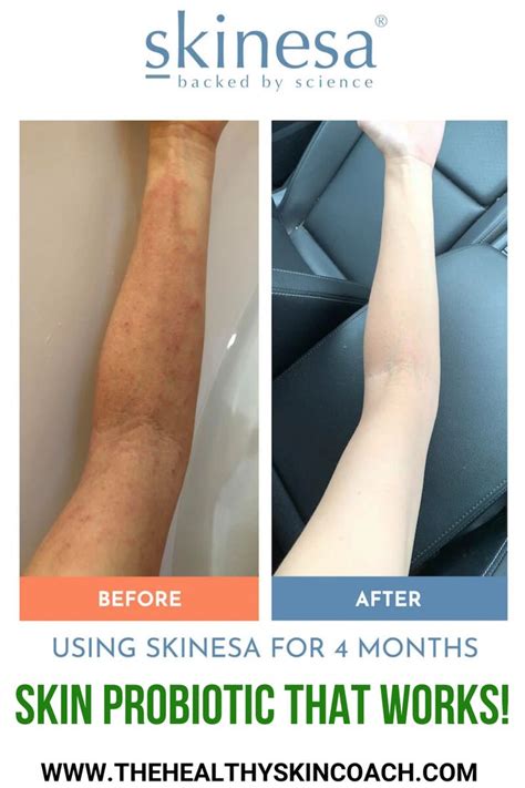 Skin Probiotic That Works!!! | Skin health, Probiotics, Skin healing