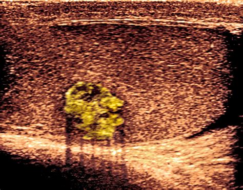 Testicular Cancerultrasound Scan Bild Kaufen 11863782 Science