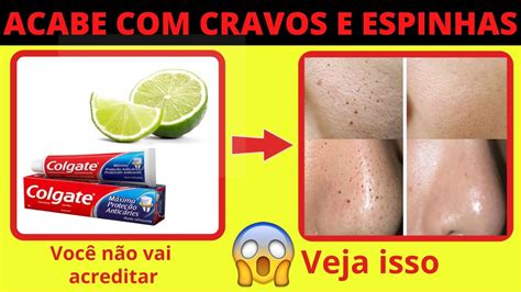 Como Tirar As Espinhas Do Rosto Em 1 Dia - Como tirar cravos e espinhas? Como tirar cravos e espinhas do rosto em ...