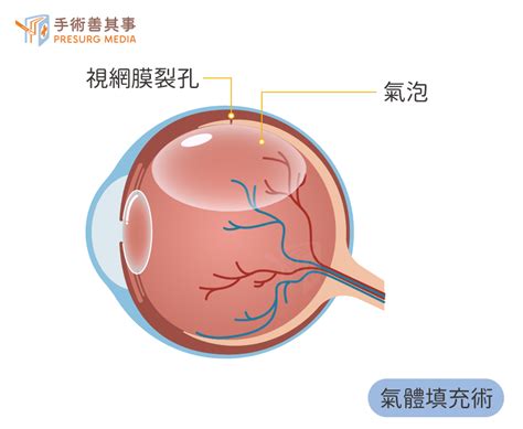 不痛不癢卻會瞎 沈默的視網膜剝離