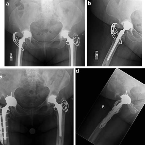 Anteroposterior Pelvis A And Lateral Right Hip B Radiographs Of Download Scientific Diagram