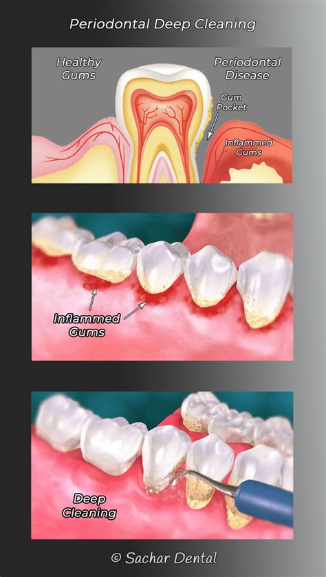 Dentist Nyc Periodontal Treatment Sachar Dental Nyc