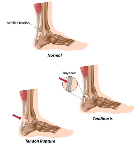 Achilles Tendon Rupture (Video) - Jeffrey H. Berg, M.D.