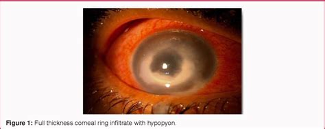 Figure 1 From Management Of Acanthamoeba Keratitis After Collagen Cross Linking For Keratoconus