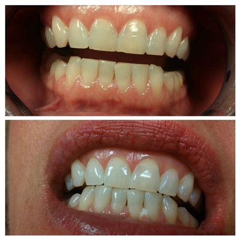 23 best images about Teeth Whitening on Pinterest | Teeth whitening ...