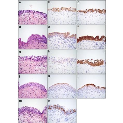 Photomicrographs Of Urothelial Carcinoma In Situ Cis And Download Scientific Diagram