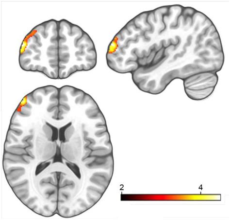 Increased Left Dorsolateral Prefrontal Cortex Density Following Escitalopram Intake During