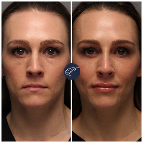 Arriba 92 Foto Under Eye Filler Before And After Lleno