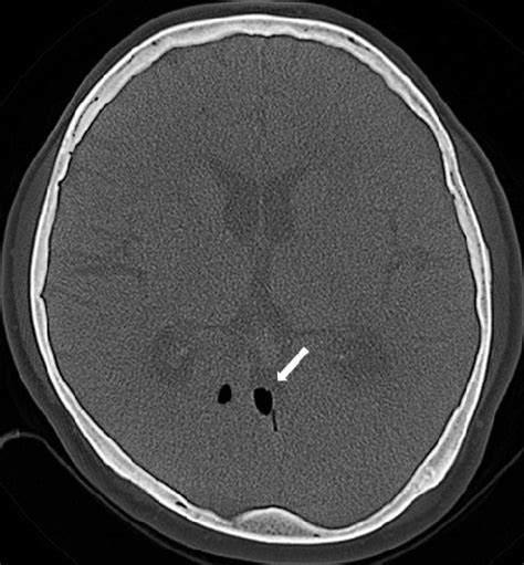 Axial brain CT scan shows pneumocephalus (arrow). | Download Scientific Diagram