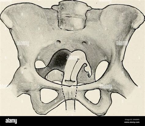 Parametritis