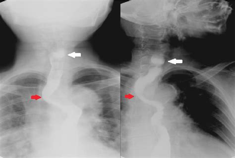 Figure 1 From Dysphagia Lusoria And Zenker S Diverticulum Dysphagia