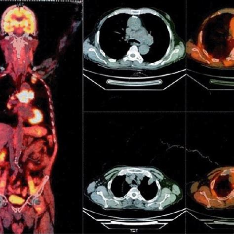 Positron emission tomography computed tomography scan at base line ...