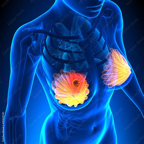 Breast Cancer Female Anatomy Tumor Highlight Stock Illustration