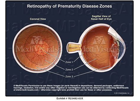 Retinopathy Of Prematurity Disease Zones