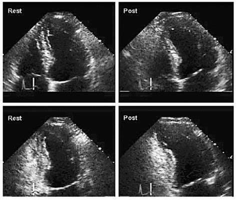 Stress Echocardiography | Thoracic Key