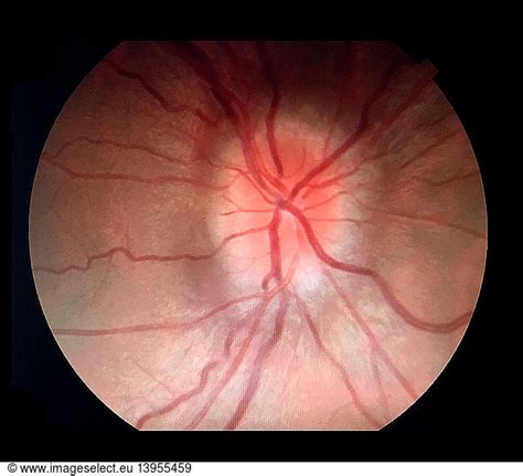 Papilledema on Fundoscopy Papilledema on Fundoscopy,abnormal ...