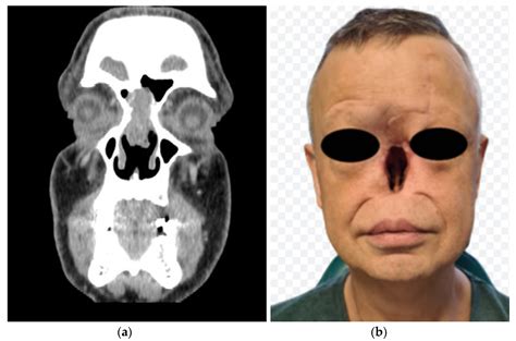 Healthcare Free Full Text The Latest Craniofacial Reconstructive