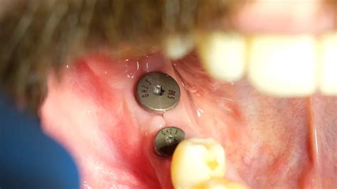 Dental Implant Abutment Definition Uses Types And Procedures