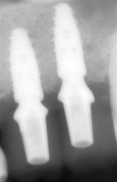 Dental Tech Chirurgia Guidata Statica Senza Boccole Infodent