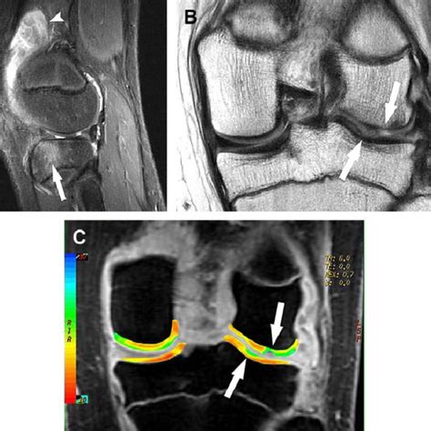 A C Sagittal Fat Suppressed A And Coronal B Fast Spin Echo Mr