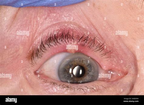 Model Released Chalazion Cyst On An Eyelid In A 78 Year Old Woman