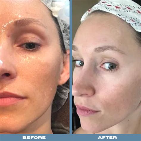 My Microneedling Real Life Before And After Experience Cornerstone Dermatology And Surgery Group