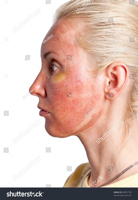 Chemical Burns On Face