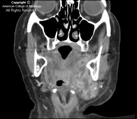 Neuroradiology On The Net Submandibular Sialadenitis