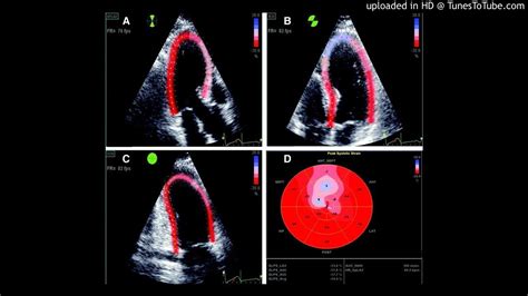 Left Ventricular Global Longitudinal Strain Gls Analysis Using Two