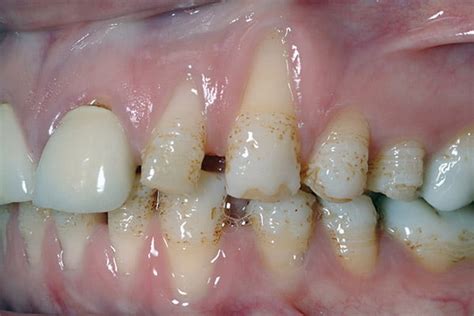 hypoplasia-02-before - Stapenhill Dental Care