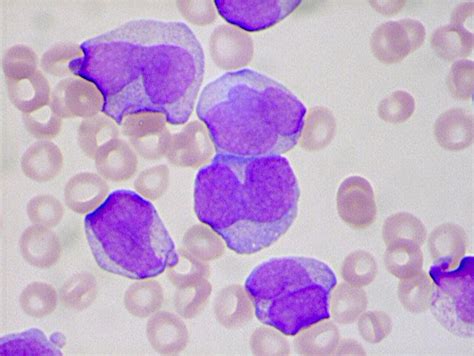 The peripheral blood smear is from a 46 year old | Chegg.com