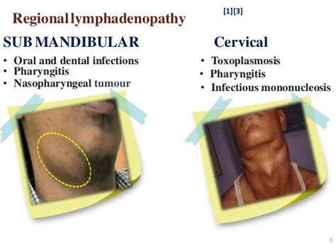 Lymphadenopathy