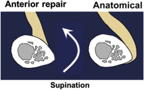 Distal Biceps Tendon Repair And Reconstruction Journal Of Hand Surgery