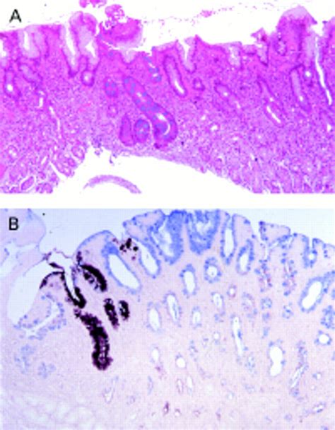 Gastric Intestinal Metaplasia Subtypes And Natural History Journal Of Clinical Pathology