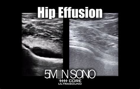 Hip Effusion – Core Ultrasound