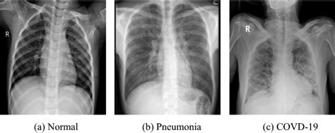 Síndrome respiratória aguda grave o que causa diagnóstico e como tratar