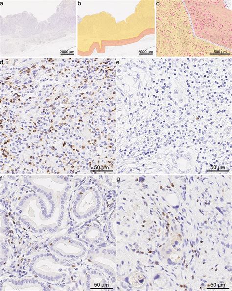 Lag Immune Cells In Gastric Cancer And Cancer Of Gastroesophageal