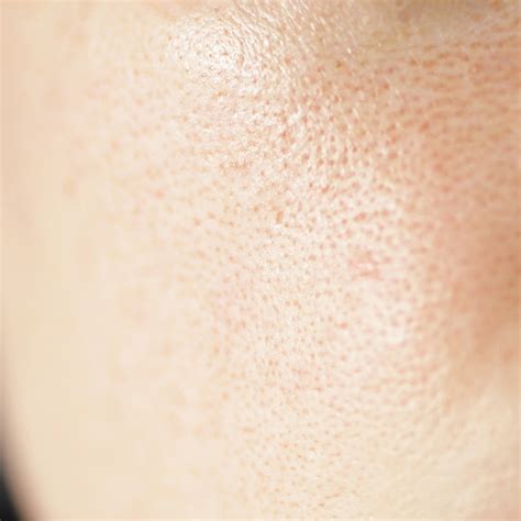 Enlarged Pores Treatment | Miami Innovative Aesthetics