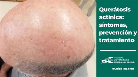 Queratosis actínica qué es prevención diagnóstico y tratamiento