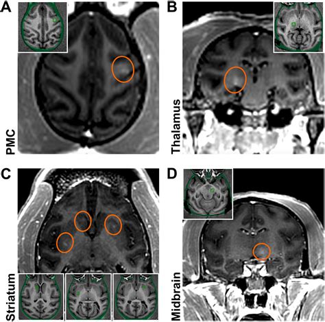 Malattie Neurodegenerative Inaugurare L Era Della Terapia Genica