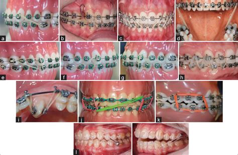 Lets Review The Intermaxillary Elastics In Orthodontics Asian Journal Of Oral Health And