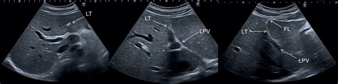 Normal Liver Anatomy Radiology Key