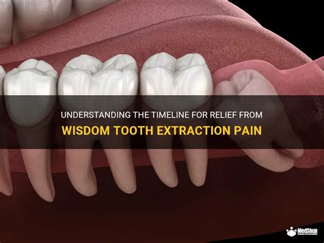 Understanding The Timeline For Relief From Wisdom Tooth Extraction Pain