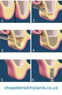 Dental bone graft complications / Complications of bone grafting for ...