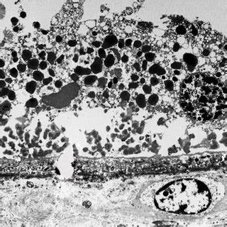 Necrotic Retinal Pigment Epithelial Rpe Cells From The Eye Of A