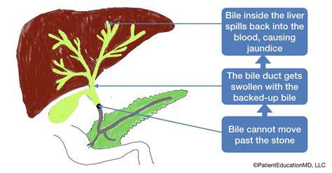 Stones in the bile duct - PatientEducationMD