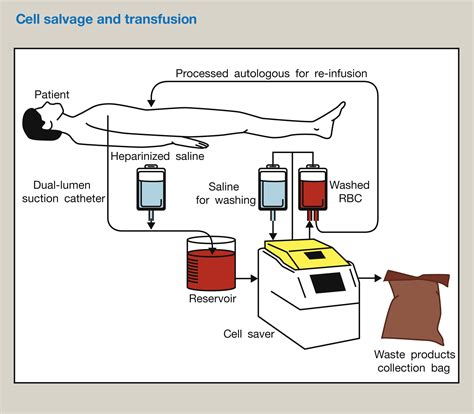 Strategies To Avoid Intraoperative Blood Transfusion Anaesthesia