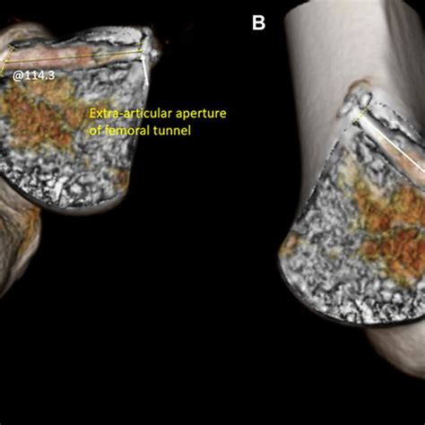 Femoral Graft Bending Angle And Femoral Tunnel Length Measurement Using