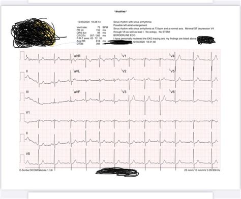 31 year male with possible left atrial enlargement. Thoughts? : r/ECG