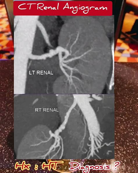 Diagnosis Ct Renal Angiogram Practical Case Radiology Youtube